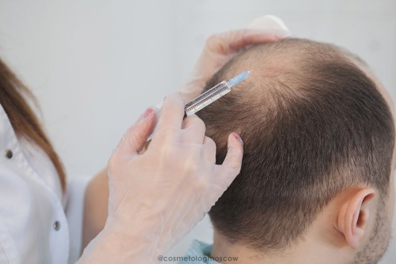 Мезотерапия для волос у мужчины